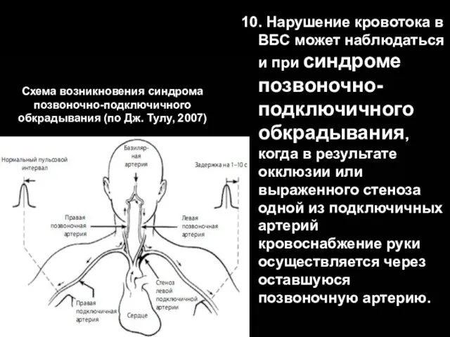 Схема возникновения синдрома позвоночно-подключичного обкрадывания (по Дж. Тулу, 2007) 10. Нарушение кровотока в
