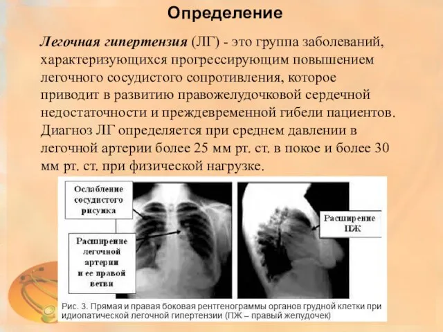 Определение Легочная гипертензия (ЛГ) - это группа заболеваний, характеризующихся прогрессирующим