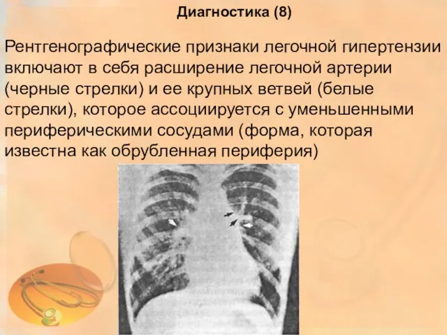 Рентгенографические признаки легочной гипертензии включают в себя расширение легочной артерии (черные стрелки) и