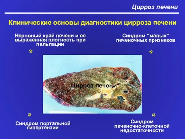 Цирроз печени Клинические основы диагностики цирроза печени Синдром портальной гипертензии