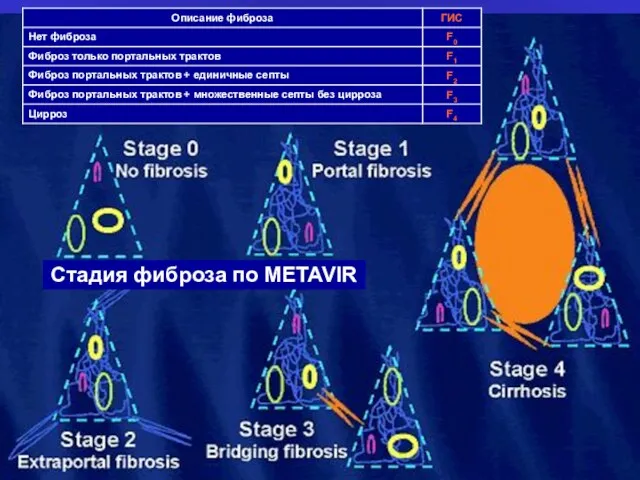 Стадия фиброза по METAVIR