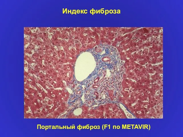 Индекс фиброза Портальный фиброз (F1 по METAVIR)