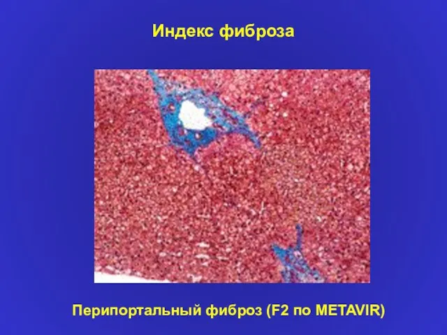 Индекс фиброза Перипортальный фиброз (F2 по METAVIR)