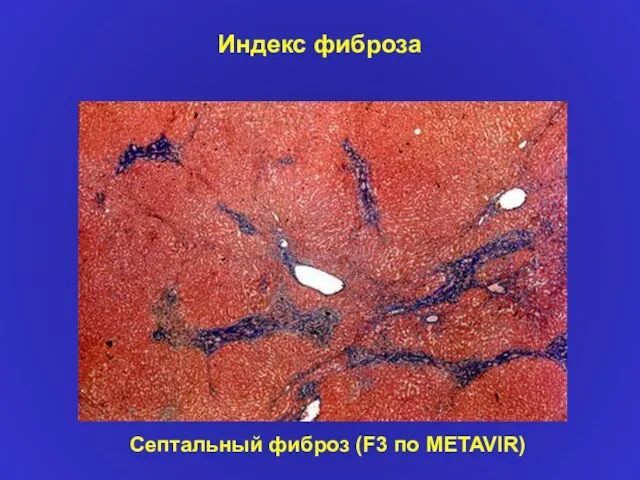 Индекс фиброза Септальный фиброз (F3 по METAVIR)