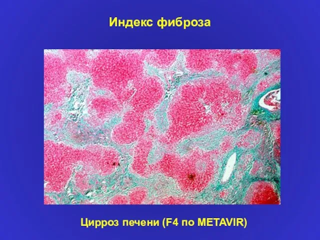 Индекс фиброза Цирроз печени (F4 по METAVIR)