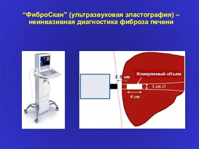 “ФиброCкан” (ультразвуковая эластография) – неинвазивная диагностика фиброза печени