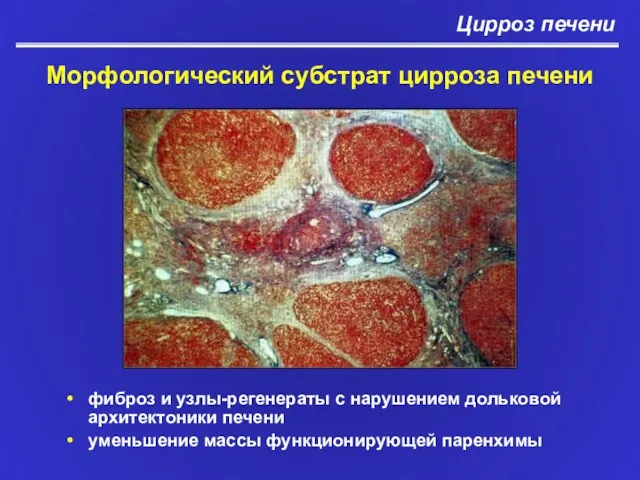Цирроз печени Морфологический субстрат цирроза печени фиброз и узлы-регенераты с