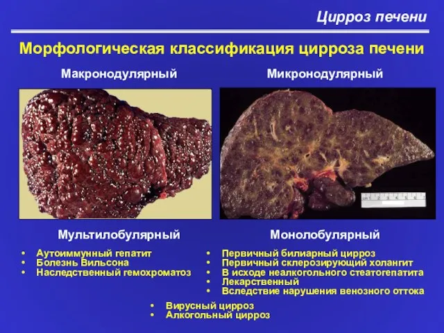 Цирроз печени Морфологическая классификация цирроза печени Макронодулярный Микронодулярный Мультилобулярный Монолобулярный