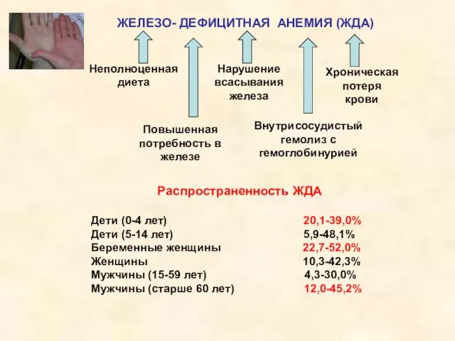 ЖЕЛЕЗО- ДЕФИЦИТНАЯ АНЕМИЯ (ЖДА) Неполноценная диета Нарушение всасывания железа Хроническая