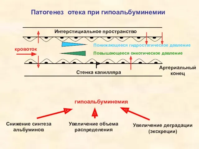 Патогенез отека при гипоальбуминемии гипоальбуминемия Снижение синтеза альбуминов Увеличение объема