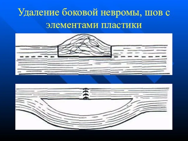 Удаление боковой невромы, шов с элементами пластики