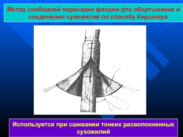 Метод свободной пересадки фасции для обертывания и соединения сухожилий по