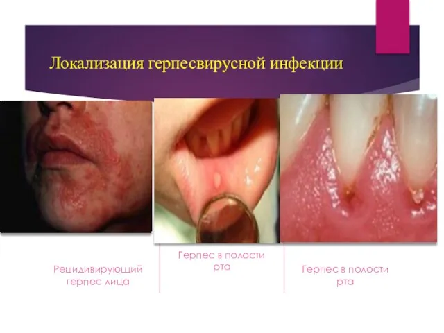Локализация герпесвирусной инфекции Рецидивирующий герпес лица Герпес в полости рта Герпес в полости рта