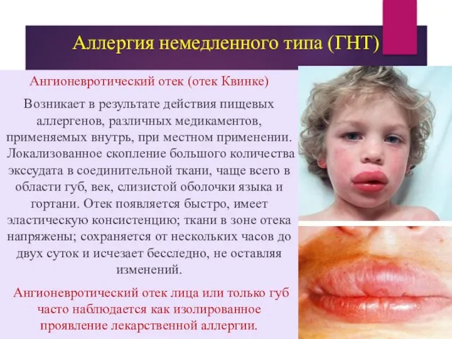 Аллергия немедленного типа (ГНТ) Ангионевротический отек (отек Квинке) Возникает в результате действия пищевых