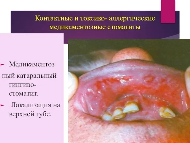 Контактные и токсико- аллергические медикаментозные стоматиты Медикаментоз ный катаральный гингиво-стоматит. Локализация на верхней губе.