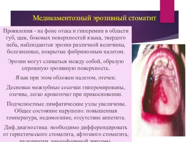 Медикаментозный эрозивный стоматит Проявления - на фоне отека и гиперемии в области губ,