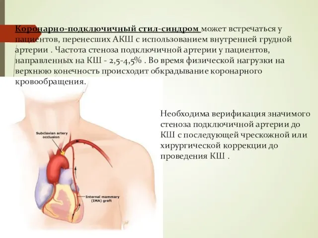 Коронарно-подключичный стил-синдром может встречаться у пациентов, перенесших АКШ с использованием