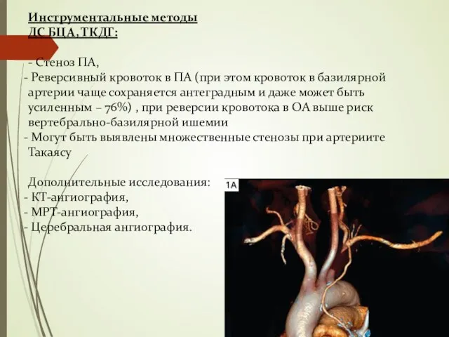 Инструментальные методы ДС БЦА, ТКДГ: - Стеноз ПА, Реверсивный кровоток