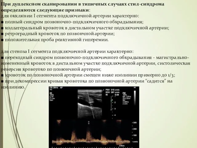 При дуплексном сканировании в типичных случаях стил-синдрома определяются следующие признаки: