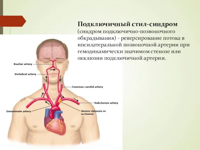 Подключичный стил-синдром (синдром подключично-позвоночного обкрадывания) - реверсирование потока в ипсилатеральной