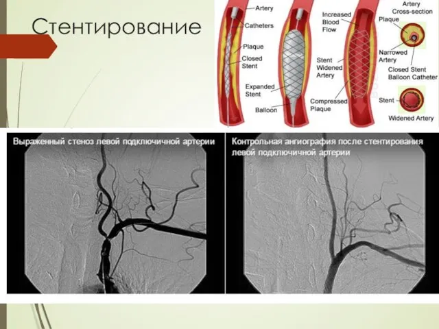 Стентирование