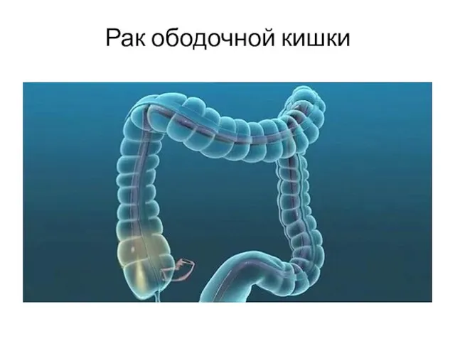 Рак ободочной кишки