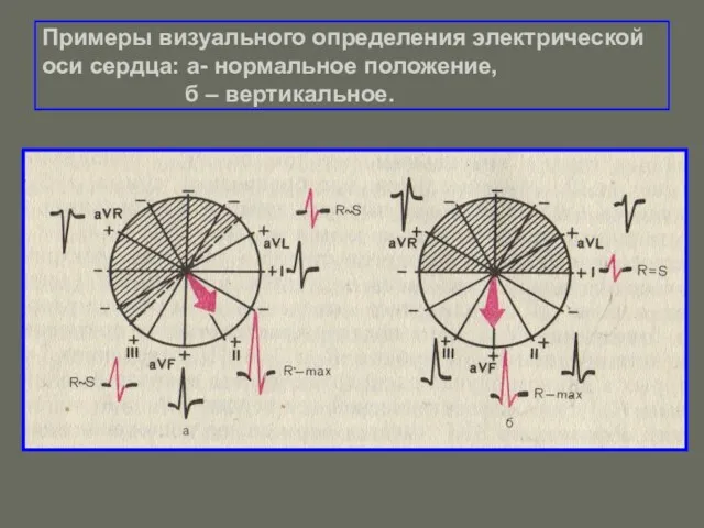 Примеры визуального определения электрической оси сердца: а- нормальное положение, б – вертикальное.