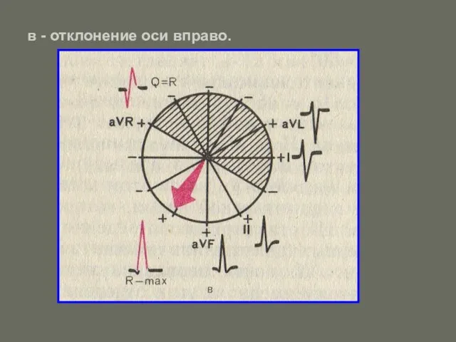 в - отклонение оси вправо.