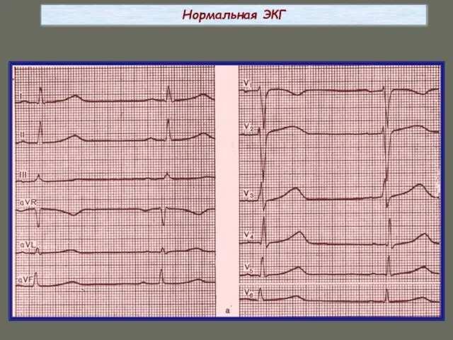 Нормальная ЭКГ