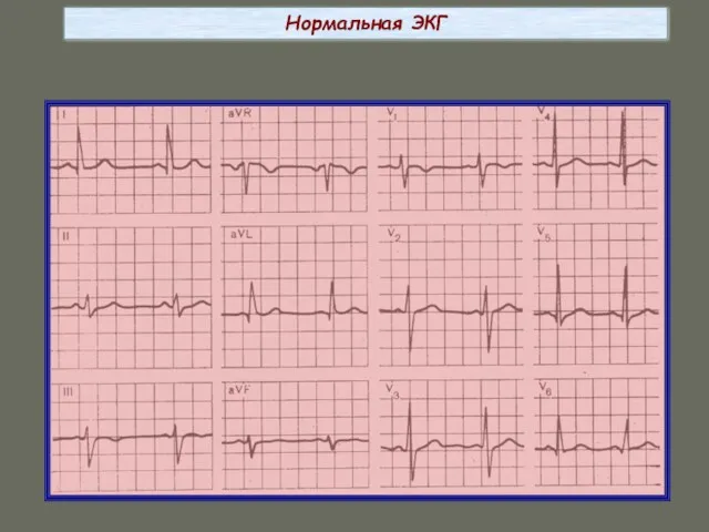 Нормальная ЭКГ