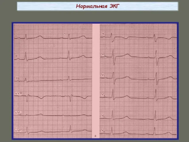 Нормальная ЭКГ