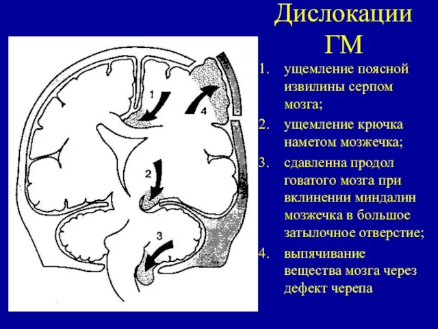 Дислокации ГМ ущемление поясной извилины серпом мозга; ущемление крючка наметом