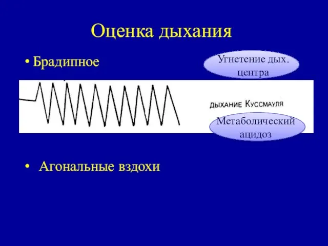 Оценка дыхания Брадипное Агональные вздохи Угнетение дых. центра Метаболический ацидоз