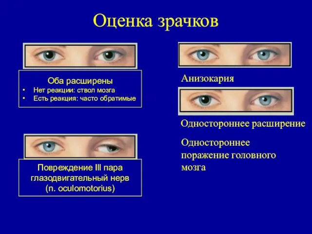 Оценка зрачков Оба расширены Нет реакции: ствол мозга Есть реакция: