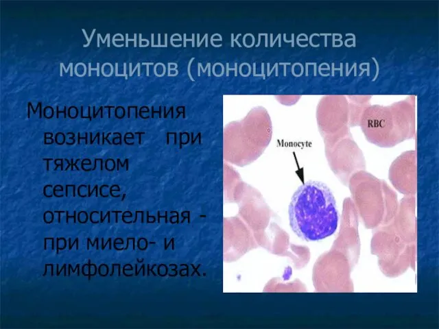 Уменьшение количества моноцитов (моноцитопения) Моноцитопения возникает при тяжелом сепсисе, относительная - при миело- и лимфолейкозах.