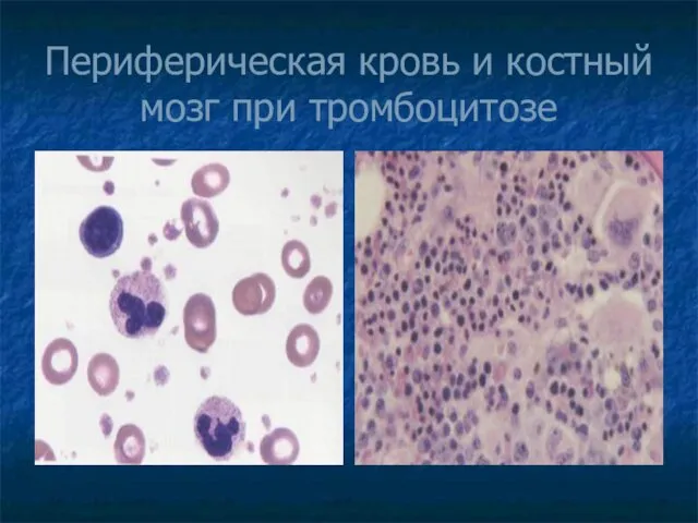 Периферическая кровь и костный мозг при тромбоцитозе