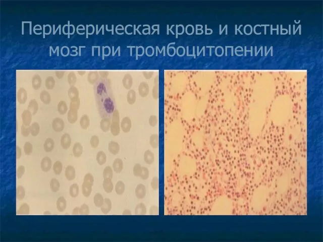 Периферическая кровь и костный мозг при тромбоцитопении