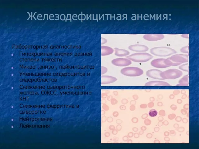Железодефицитная анемия: Лабораторная диагностика Гипохромная анемия разной степени тяжести Микро-,анизо-,