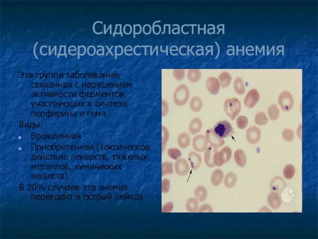 Сидоробластная (сидероахрестическая) анемия Эта группа заболеваний, связанная с нарушением активности