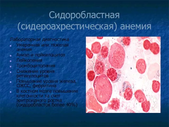 Сидоробластная (сидероахрестическая) анемия Лабораторная диагностика Умеренная или тяжелая анемия Анизо-и