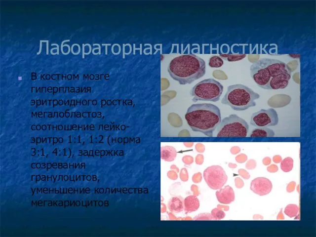 Лабораторная диагностика В костном мозге гиперплазия эритроидного ростка, мегалобластоз, соотношение