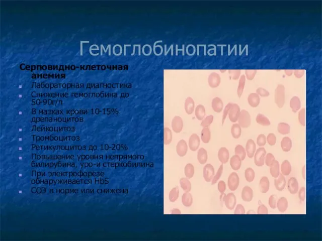 Гемоглобинопатии Серповидно-клеточная анемия Лабораторная диагностика Снижение гемоглобина до 50-90г/л В