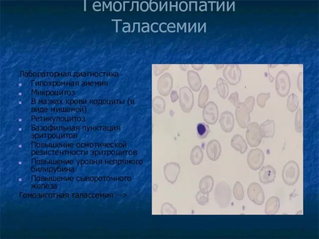Гемоглобинопатии Талассемии Лабораторная диагностика Гипохромная анемия Микроцитоз В мазках крови