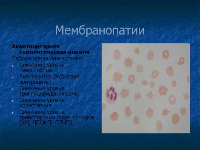 Мембранопатии Акантоцитарная гемолитическая анемия Лабораторная диагностика: Снижение уровня гемоглобина Акантоцитоз