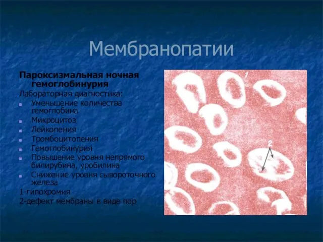 Мембранопатии Пароксизмальная ночная гемоглобинурия Лабораторная диагностика: Уменьшение количества гемоглобина Микроцитоз