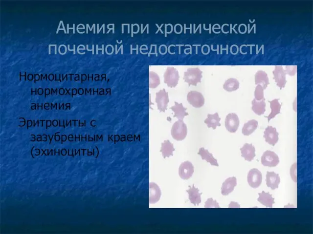 Анемия при хронической почечной недостаточности Нормоцитарная, нормохромная анемия Эритроциты с зазубренным краем (эхиноциты)