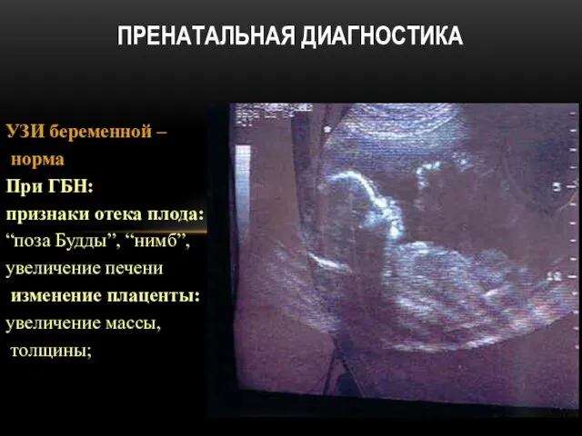 УЗИ беременной – норма При ГБН: признаки отека плода: “поза Будды”, “нимб”, увеличение