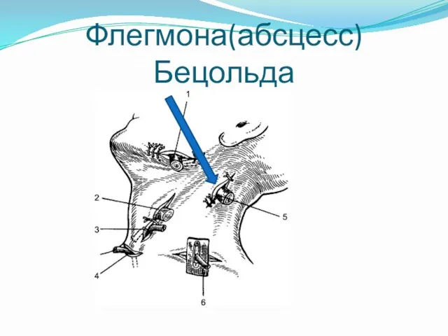 Флегмона(абсцесс)Бецольда