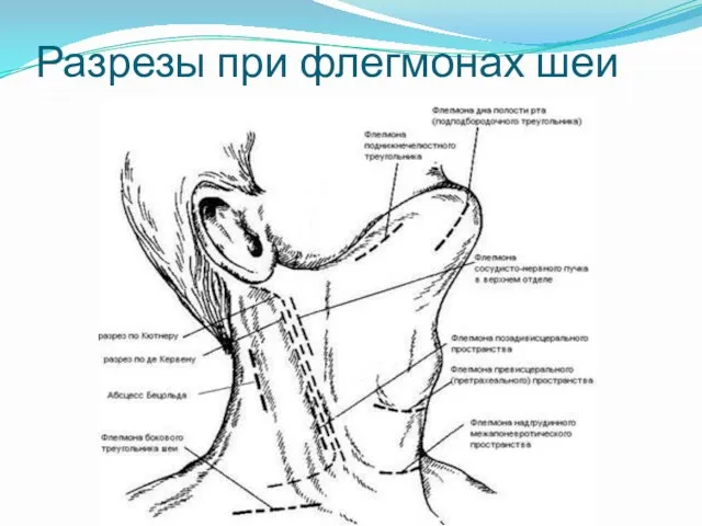 Разрезы при флегмонах шеи