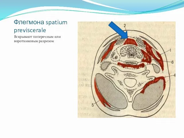 Флегмона spatium previscerale Вскрывают поперечным или воротниковым разрезом